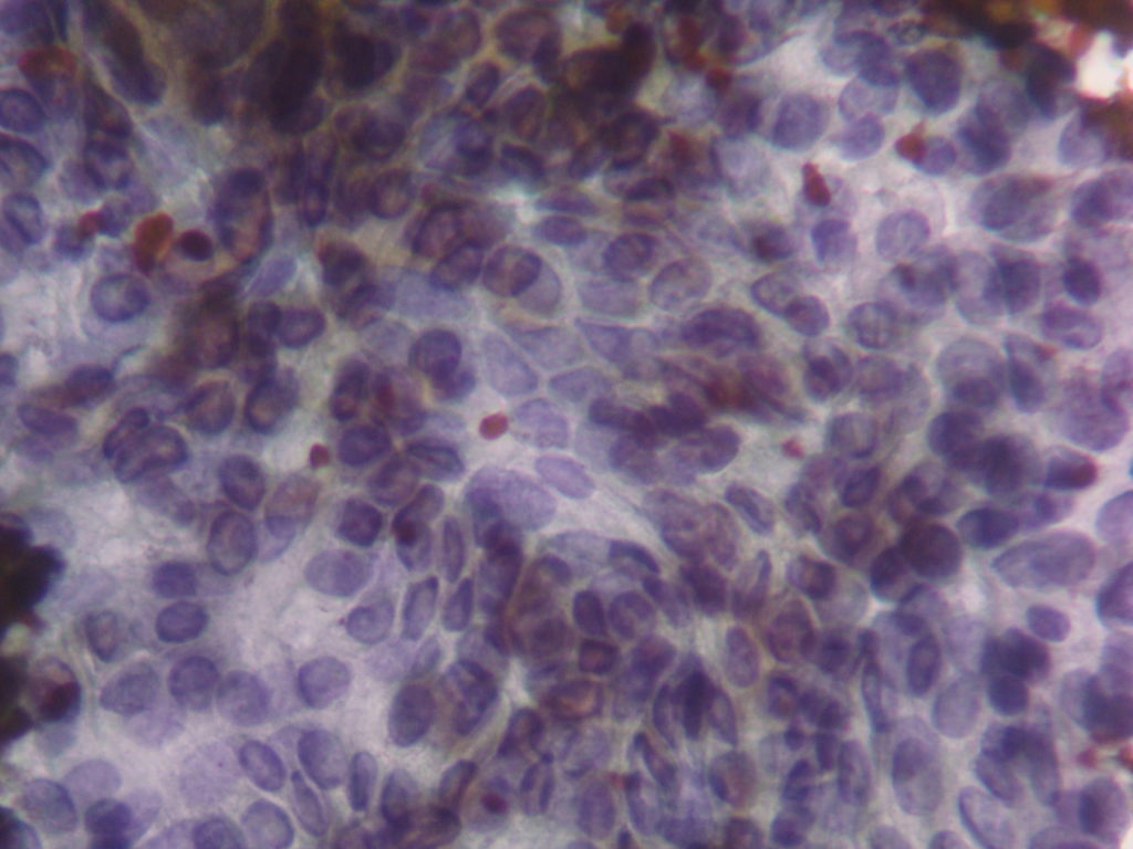 Fig. 3 aspetto citologico su agoaspirato tiroideo di tumore papillare della tiroide